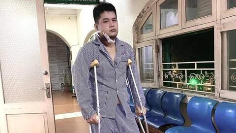 3 triệu chứng KINH ĐIỂN của u xương hàm - Căn bệnh từng khiến Long Chun bị BIẾN DẠNG gương mặt