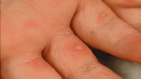 Bệnh tay chân miệng: Nguyên nhân, triệu chứng và các biện pháp phòng ngừa
