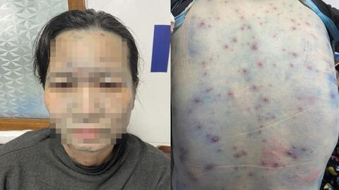 Bệnh nhân mắc thủy đậu có bệnh nền dễ bị biến chứng