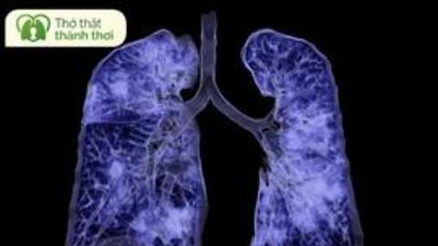 Omicron có thể gây sưng phổi - 14 dấu hiệu bạn không bao giờ được bỏ qua