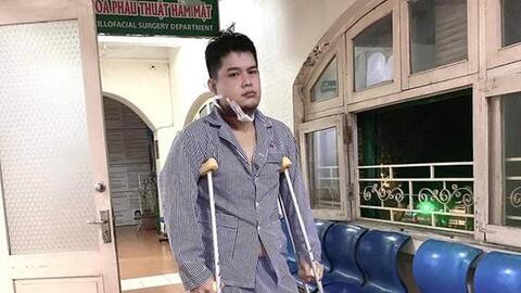 3 triệu chứng KINH ĐIỂN của u xương hàm - Căn bệnh từng khiến Long Chun bị BIẾN DẠNG gương mặt