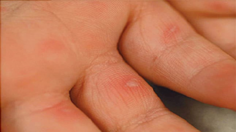 Bệnh tay chân miệng: Nguyên nhân, triệu chứng và các biện pháp phòng ngừa