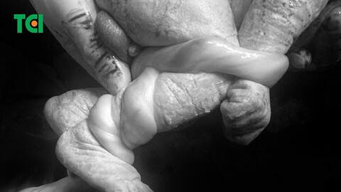 Cứu sống thai nhi bị suy thai do 5 vòng dây rốn quấn chặt