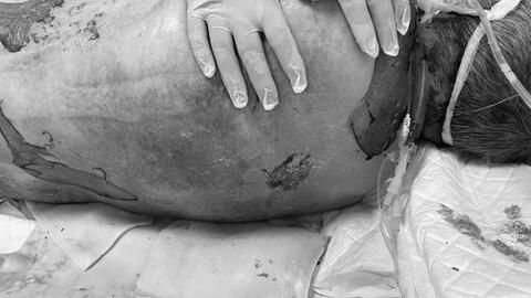 Bệnh nhân bị hoại tử thượng bì do nhiễm độc