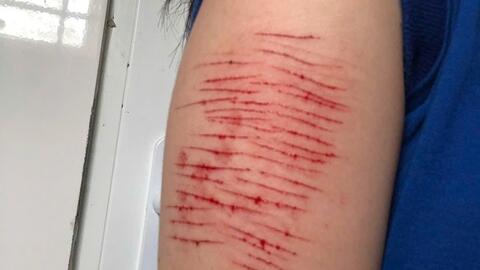 Lý giải trường hợp thanh thiếu niên mắc bệnh tâm lý tự rạch tay