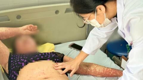 Bệnh nhân bị ứng thuốc nặng khiến men gan tăng 8 lần