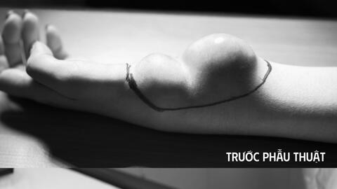 Giữ lại tay cho bệnh nhân ung thư hiếm gặp