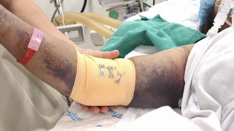 Nhiều bệnh nhân sốc và xuất huyết do mắc sốt xuất huyết