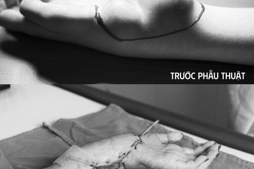 Giữ lại tay cho bệnh nhân ung thư hiếm gặp