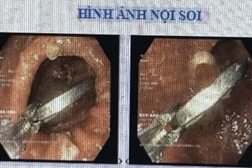 Nuốt dị vật khi chơi tiền xu, bé 11 tuổi nhập viện khẩn cấp