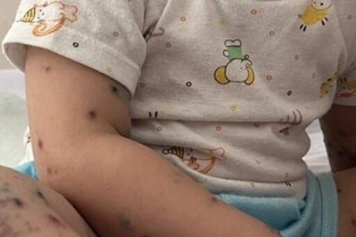 Vaccine phòng tay chân miệng được cấp phép tại Việt Nam