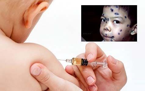 Tiêm vaccine giúp phòng ngừa bệnh thủy đậu hiệu quả, đơn giản