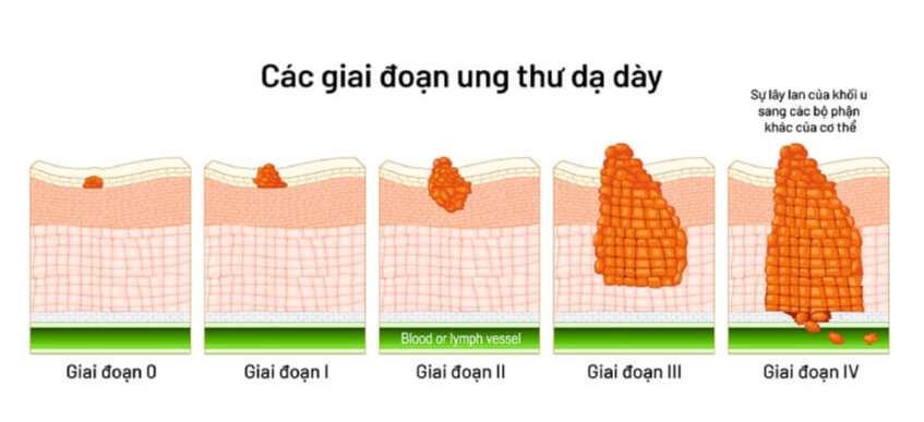 Thấy có biểu hiện này mỗi khi ăn, cảnh giác với dấu hiệu cảnh báo sớm của bệnh ung thư dạ dày - Ảnh 1.