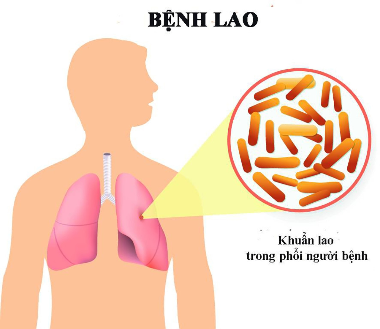 Thủ tướng chỉ đạo tăng cường công tác phòng, chống bệnh Lao- Ảnh 1.