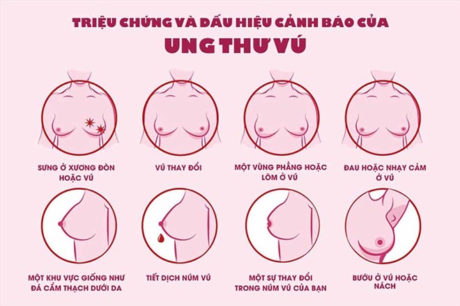 5 bước để phát hiện sớm ung thư vú